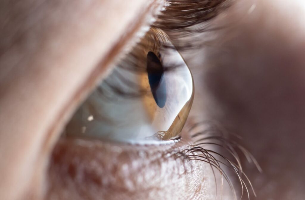 Close up of an eye with a doming, cone-like shape to the cornea exhibiting keratoconus